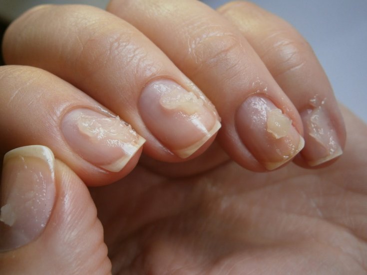 Why nails hurt after removing gel polish | Online store ThePilochki
